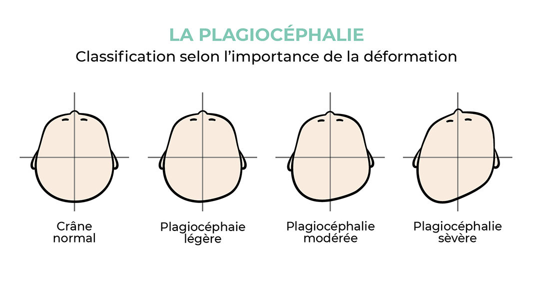 les différents types de plagiocéphalie