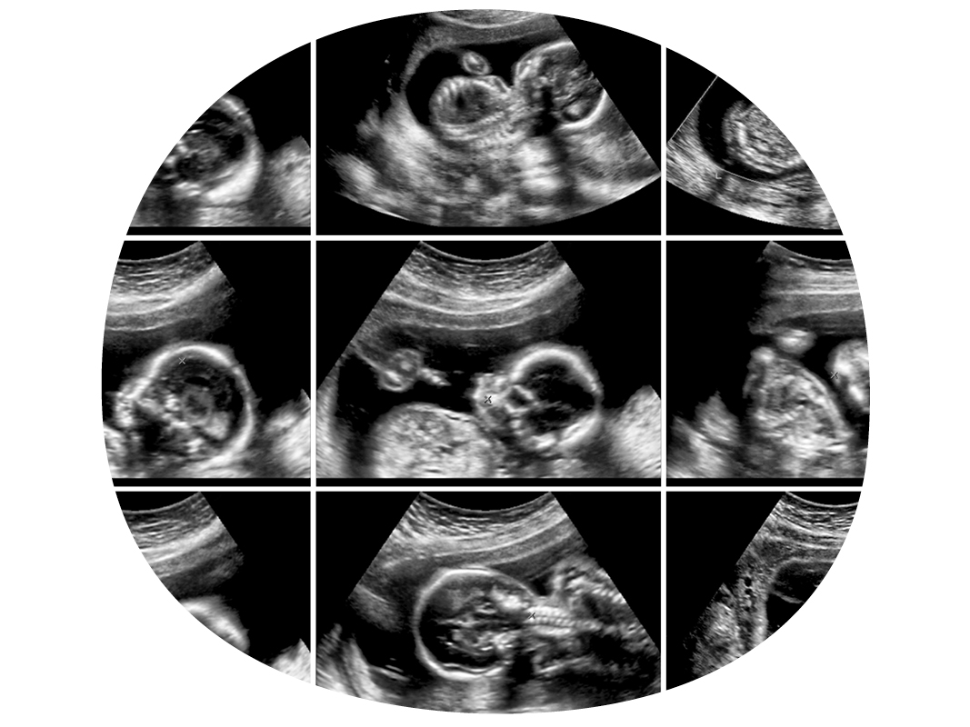 échographie du deuxième trimestre de grossesse